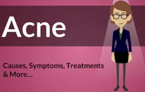Acne (Pimples): Causes, Treatments