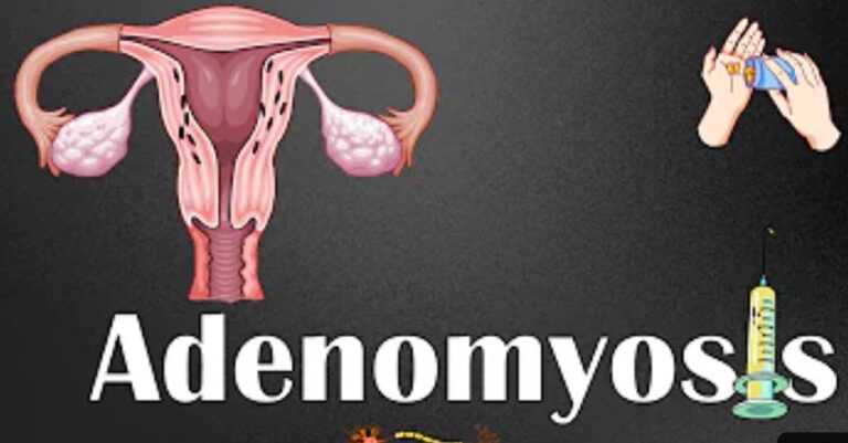 Adenomyosis: Causes, Symptoms, Treatment