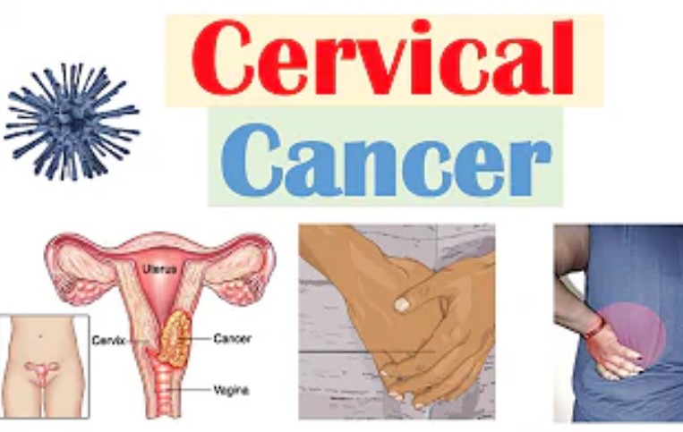 Cervical Cancer: Causes, Prevention, Treatment