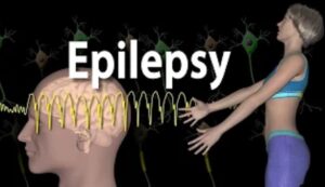 Convulsion/Epilepsy/Seizure