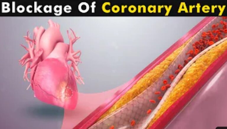 Coronary Artery Disease: Causes, Prevention, Treatment