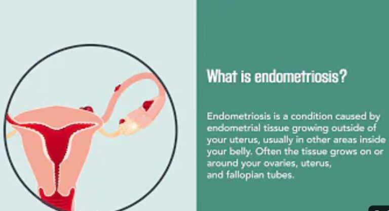 Endometriosis: Causes, Symptoms, Treatment