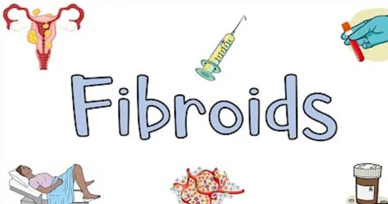 Fibroids: Causes, Symptoms, Management/Treatment