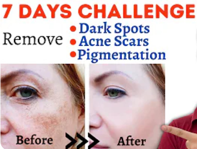 How to Make Acne Scars And Dark Spot Serum