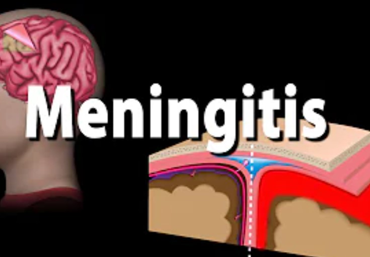 Meningitis: Causes, symptoms, prevention, Treatment!