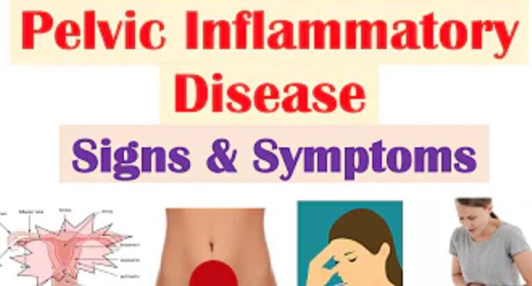 Pelvic Inflammatory Disease: Causes, Symptoms, Treatment, Complications