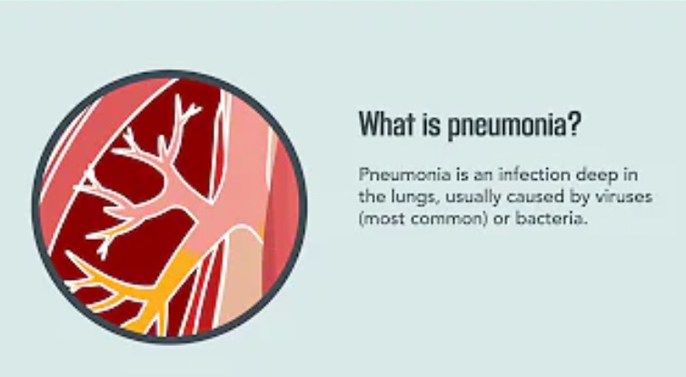 Pneumonia: Causes, Symptoms, Treatment, Prevention