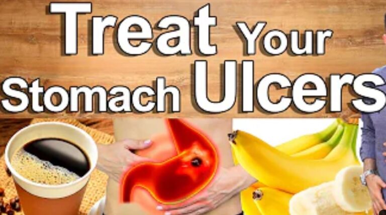 Stomach Ulcer: Causes, What to Do, Prevention, Foods!