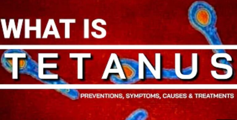 Tetanus: Causes, Symptoms, Treatment, Prevention