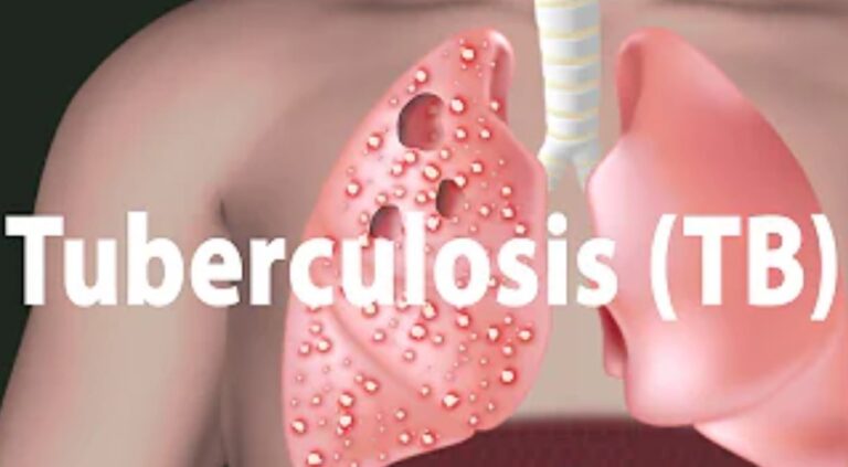 Tuberculosis: Causes, Symptoms, Treatment, Prevention