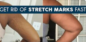 How to Make Stretch Mark Scrub