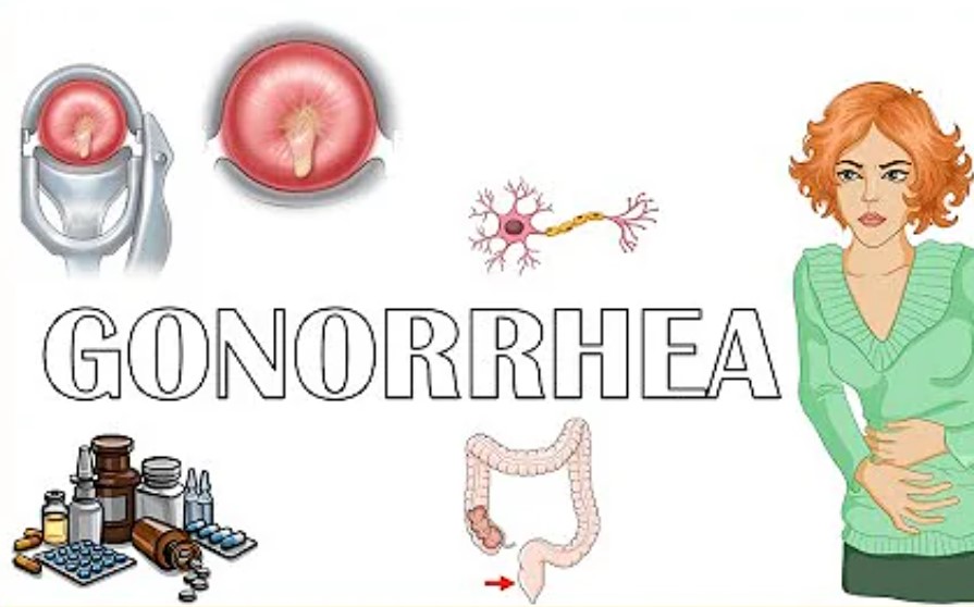 Gonorrhea in Tagalog