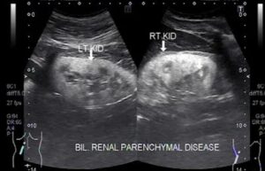 Renal Parenchymal Disease