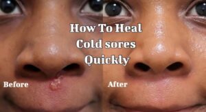 Skincare for Cold Sores