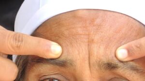Skincare for Forehead Wrinkles