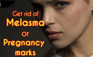 Skincare for Melasma During Pregnancy