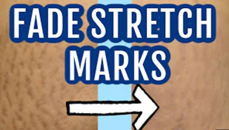 Stretch Marks: Causes, Prevention, and Treatment