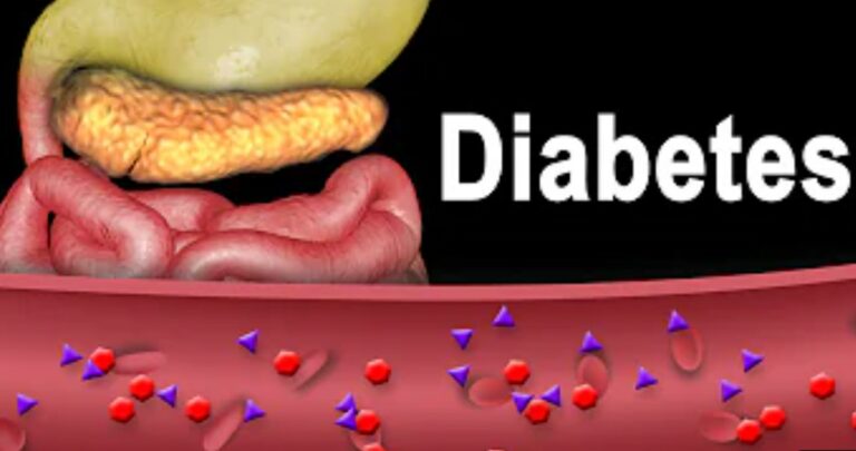 Type 4 Diabetes: Causes, Diagnosis and Management