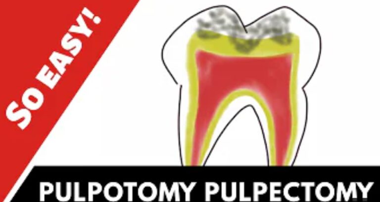 What is Pulpotomy: Advantage and Disadvantage