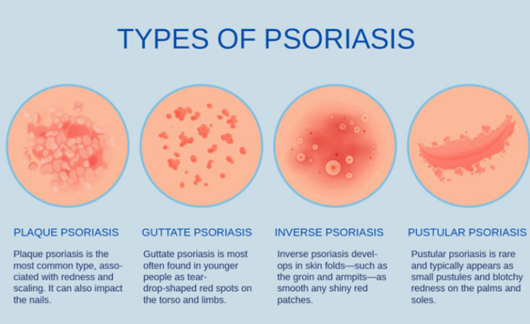 Skincare for Psoriasis