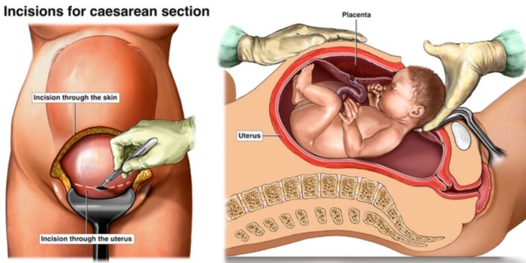 Caesarean Section: meaning, reasons to do C-section