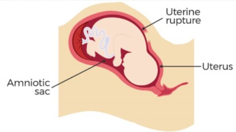 Uterine Rupture: Causes, Treatment, Prevention