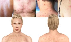 Skincare for acne-prone body areas